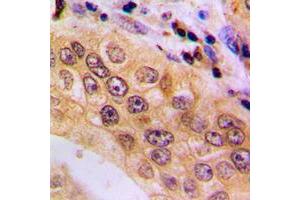 Immunohistochemical analysis of NFAT3 (pS676) staining in human lung cancer formalin fixed paraffin embedded tissue section.
