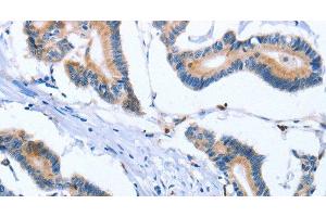 Immunohistochemistry of paraffin-embedded Human colon cancer tissue using FNK Polyclonal Antibody at dilution 1:30 (PLK3 anticorps)