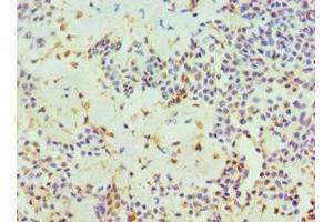 Immunohistochemistry of paraffin-embedded human breast cancer using ABIN7162382 at dilution of 1:100 (HIV-1 Tat Interactive Protein 2, 30kDa (HTATIP2) (AA 1-230) anticorps)