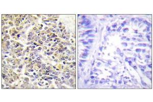 Immunohistochemistry analysis of paraffin-embedded human lung carcinoma tissue using ASC antibody. (STS anticorps  (N-Term))