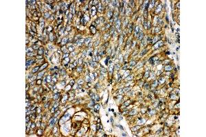 Anti-Aquaporin 6 antibody, IHC(P) IHC(P): Human Lung Cancer Tissue (AQP6 anticorps  (C-Term))