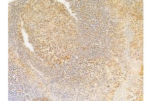 ABIN7095311 and ABIN7099368 at 1/100 staining human tongue carcinoma by IHC-P. (SOHLH2 anticorps)