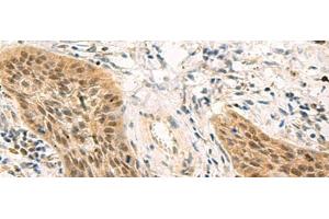 Immunohistochemistry of paraffin-embedded Human esophagus cancer tissue using PSME1 Polyclonal Antibody at dilution of 1:50(x200) (PSME1 anticorps)