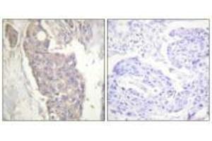 Immunohistochemistry analysis of paraffin-embedded human breast carcinoma tissue using Fas antibody. (FAS anticorps  (C-Term))