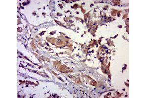 Paraformaldehyde-fixed, paraffin embedded human breast carcinoma, Antigen retrieval by boiling in sodium citrate buffer (pH6.