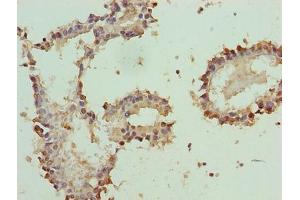 Immunohistochemistry of paraffin-embedded human breast cancer using ABIN7160433 at dilution of 1:100