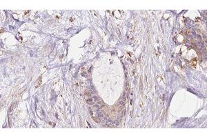 ABIN6273045 at 1/100 staining Human liver cancer tissue by IHC-P. (EXOC1 anticorps  (N-Term))