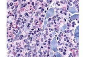 Immunohistochemical (Formalin/PFA-fixed paraffin-embedded sections) staining in human neoplastic cells with NANP polyclonal antibody . (NANP anticorps)