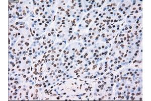 Immunohistochemical staining of paraffin-embedded Adenocarcinoma of colon tissue using anti-TYRO3mouse monoclonal antibody. (TYRO3 anticorps)