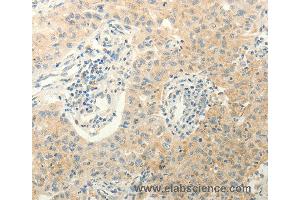 Immunohistochemistry of Human lung cancer using ERG Polyclonal Antibody at dilution of 1:40 (ERG anticorps)