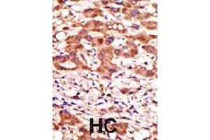 Formalin-fixed and paraffin-embedded human hepatocellular carcinoma tissue reacted with MGAT1 polyclonal antibody  , which was peroxidase-conjugated to the secondary antibody, followed by AEC staining . (MGAT1 anticorps  (N-Term))