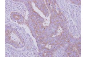 IHC-P Image Immunohistochemical analysis of paraffin-embedded human colon carcinoma, using HGS, antibody at 1:500 dilution. (HGS anticorps  (C-Term))