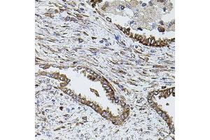 Immunohistochemistry of paraffin-embedded human lung cancer using SHH antibody. (Sonic Hedgehog anticorps)