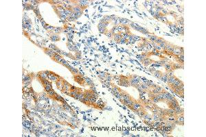 Immunohistochemistry of Human lung cancer using TRPA1 Polyclonal Antibody at dilution of 1:60 (TRPA1 anticorps)