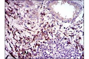Immunohistochemical analysis of paraffin-embedded lung cancer tissues using TGFb1 mouse mAb with DAB staining.