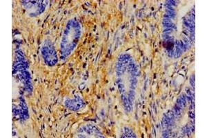 Immunohistochemistry of paraffin-embedded human colon cancer using ABIN7154609 at dilution of 1:100 (ERAL1 anticorps  (AA 271-382))