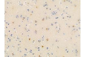 ABIN6266116 and ABIN6278648 at 1/100 staining human glioblastoma by IHC-P. (ZNF23 anticorps  (Internal Region))