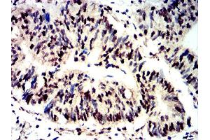 Immunohistochemical analysis of paraffin-embedded rectum cancer tissues using Phospho-4E-BP1 (Ser65) mouse mAb with DAB staining. (eIF4EBP1 anticorps  (pSer65))