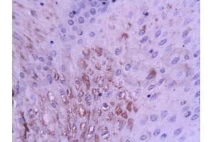 Formalin-fixed and paraffin embedded human esophageal cancer tissue labeled with Anti-WIG 1/PAG608 (3E4) Monoclonal Antibody, Unconjugated(bsm-0957M) at 1:200 followed by conjugation to the secondary antibody and DAB staining