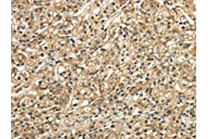 The image on the left is immunohistochemistry of paraffin-embedded Human prostate cancer tissue using ABIN7128049(TSC22D1 Antibody) at dilution 1/30, on the right is treated with fusion protein. (TSC22D1 anticorps)