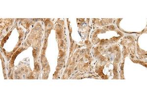 Immunohistochemistry of paraffin-embedded Human thyroid cancer tissue using ZUFSP Polyclonal Antibody at dilution of 1:35(x200) (ZUFSP anticorps)