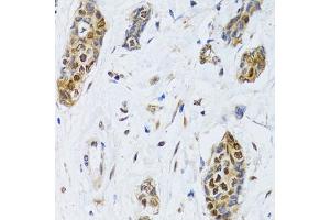 Immunohistochemistry of paraffin-embedded human breast cancer using CIRBP antibody (ABIN5973938) at dilution of 1/100 (40x lens). (CIRBP anticorps)
