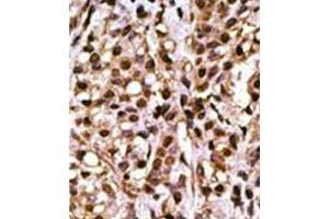 Formalin-Fixed Paraffin-embedded human cancer tissue reacted with the primary antibody, which was peroxidase-conjugated to the secondary antibody, followed by DAB staining. (ATG4A anticorps  (C-Term))