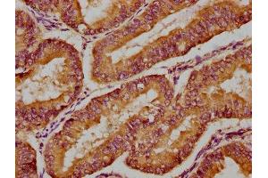 IHC image of ABIN7160647 diluted at 1:300 and staining in paraffin-embedded human endometrial cancer performed on a Leica BondTM system.