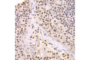 Immunohistochemistry of paraffin-embedded human amygdalitis using HMGB1 Antibody. (HMGB1 anticorps  (AA 100-200))
