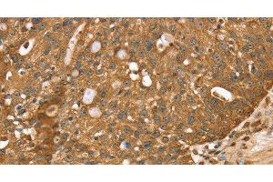 Immunohistochemistry of paraffin-embedded Human breast cancer using STARD5 Polyclonal Antibody at dilution of 1:40 (STARD5 anticorps)