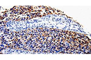 Immunohistochemistry of paraffin-embedded Human renal cancer tissue using COX10 Polyclonal Antibody at dilution 1:100 (COX10 anticorps)
