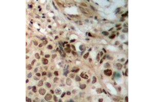 Immunohistochemical analysis of JAK2 staining in human breast cancer formalin fixed paraffin embedded tissue section. (JAK2 anticorps)