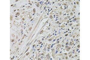 Immunohistochemistry of paraffin-embedded Human prostate cancer using SMARCC2 Polyclonal Antibody at dilution of 1:100 (40x lens). (SMARCC2 anticorps)