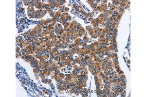 Immunohistochemistry of Human colon cancer using CADM3 Polyclonal Antibody at dilution of 1:40 (CADM3 anticorps)