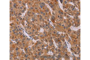 Immunohistochemistry of Human breast cancer using CALCA Polyclonal Antibody at dilution of 1:40 (CGRP anticorps)