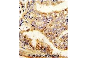 Formalin-fixed and paraffin-embedded human prostate carcinoma reacted with PUM2 Antibody , which was peroxidase-conjugated to the secondary antibody, followed by DAB staining. (PUM2 anticorps  (AA 159-189))