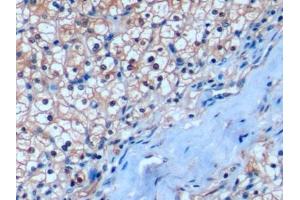 Detection of ICOSLG in Human Renal cancer Tissue using Polyclonal Antibody to Inducible T-Cell Co Stimulator Ligand (ICOSLG)