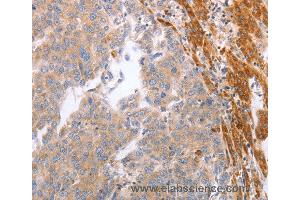 Immunohistochemistry of Human breast cancer using NRTN Polyclonal Antibody at dilution of 1:60 (Neurturin anticorps)