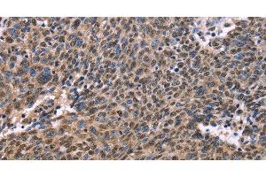 Immunohistochemistry of paraffin-embedded Human ovarian cancer using EVC2 Polyclonal Antibody at dilution of 1:40 (EVC2 anticorps)