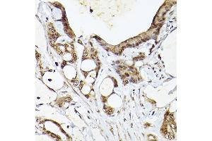 Immunohistochemistry of paraffin-embedded human colon carcinoma using UBQLN4 Rabbit pAb (ABIN7271124) at dilution of 1:150 (40x lens). (UBQLN4 anticorps  (AA 300-390))
