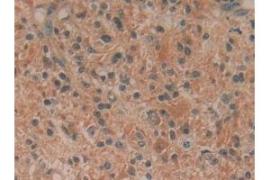 Detection of HPRT1 in Human Glioma Tissue using Polyclonal Antibody to Hypoxanthine Phosphoribosyltransferase 1 (HPRT1)