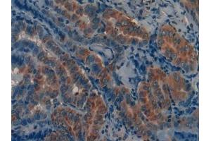 Detection of MMP12 in Human Thyroid cancer Tissue using Polyclonal Antibody to Matrix Metalloproteinase 12 (MMP12)