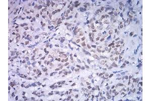Immunohistochemical analysis of paraffin-embedded breast cancer tissues using ATF4 mouse mAb with DAB staining.
