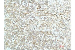 Immunohistochemical analysis of paraffin-embedded Human Breast Carrcinoma Tissue using a-actinin Mouse mAb diluted at 1:200. (ACTN1 anticorps)