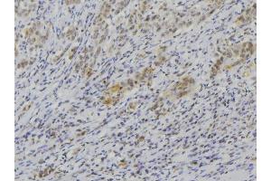 ABIN6272589 at 1/100 staining Human lung cancer tissue by IHC-P. (IL1F9 anticorps  (N-Term))