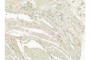 ABIN6256874 and ABIN6274505 at 1/100 staining human esophageal carcinoma by IHC-P. (XRN2 anticorps  (N-Term))