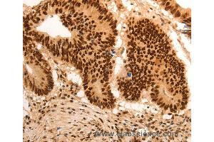 Immunohistochemistry of Human gastic cancer using E2F7 Polyclonal Antibody at dilution of 1:60 (E2F7 anticorps)