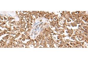 Immunohistochemistry of paraffin-embedded Human ovarian cancer tissue using USP16 Polyclonal Antibody at dilution of 1:25(x200) (USP16 anticorps)