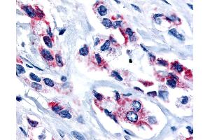 Anti-ESRRB / ERR Beta antibody IHC of human Prostate, Carcinoma. (ESRRB anticorps  (Internal Region))