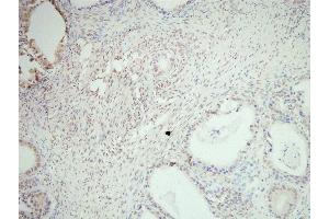 SNAI2 Antibody(ABIN6276471) staining human ovarian cancer tissue sections by IHC-f at 1:200. (SLUG anticorps  (Internal Region))